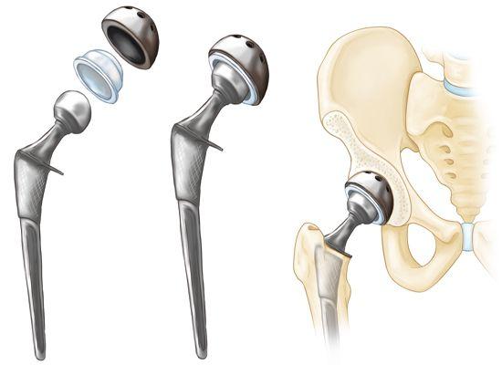 AVN Hip Treatment and Core Decompression