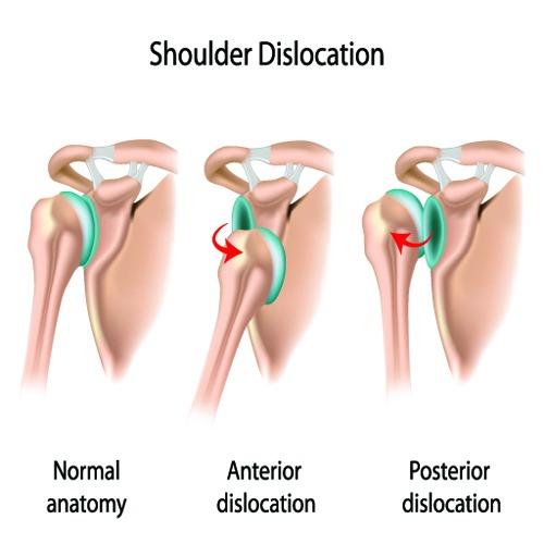 Rotator Cuff and Bankart Surgery